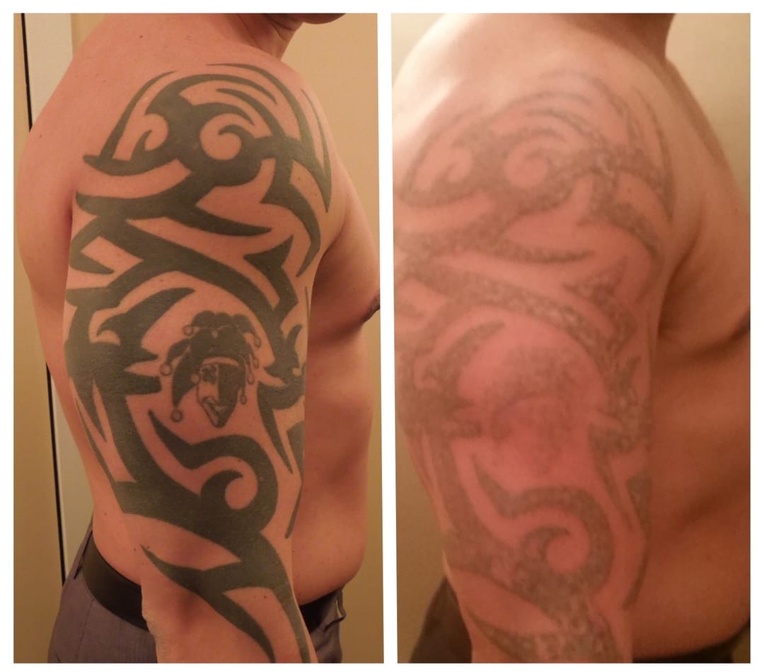 Tattoo Removal Before And After Sleeve | www.imgkid.com ...